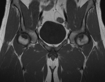 MRI scans showing avascular necrosis in both hips