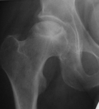 Avascular Necrosis of femoral head associated with collapse of femoral head