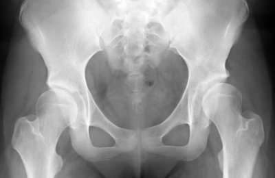 Dysplasia of the Both Hips
