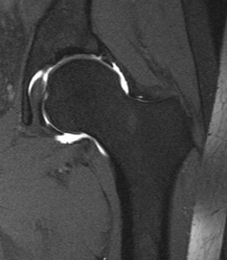 MRI Arthrogram show evidence of labral tear and cam impingement in the Left Hip