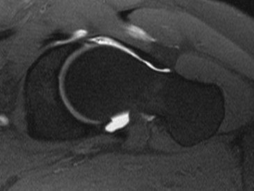 MRI Arthrogram show evidence of labral tear and cam impingement in the Left Hip 2