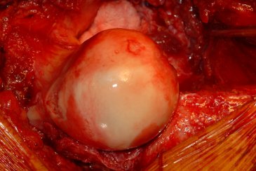 Intraoperative picture showing reshaping of the ball portion of the hip joint