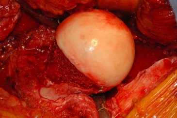 Intraoperative picture showing reshaping of the ball portion of the hip joint 2