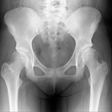 hip dysplasia xray vs normal