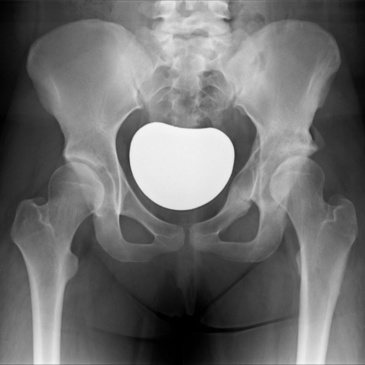 hip dysplacia xray shoing normal