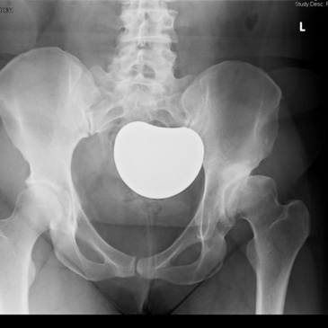 X-rays of a patient who has had Left Total hip arthroplasty for arthritis associated with hip dysplasia - figure 1