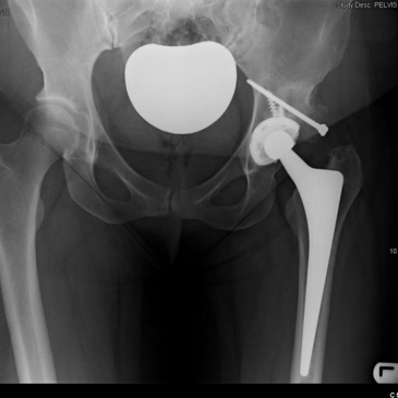 X-rays of a patient who has had Left Total hip arthroplasty for arthritis associated with hip dysplasia - figure 2