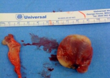 Excised synovium and nodule specimen from PVNS of hip joint