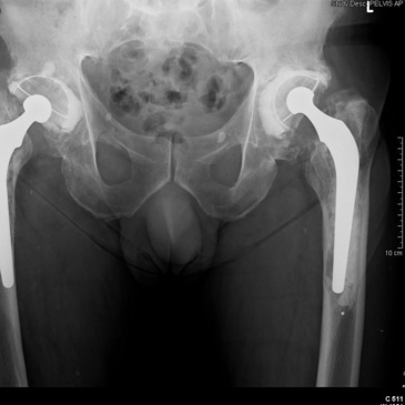 Failed bilateral hip arthroplasties