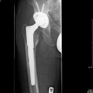 Revision Right Total Hip arthroplasty