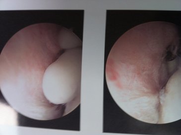 Arthroscopic view of loose bodies 